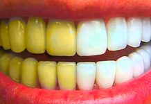 არსებობს საკმაოდ ეფქტური რამდენიმე ხალხური მეთოდი, რომელთა დახმარებით კბილებიდან ქვებს მოიცილებთ და ამავდროულად გაითეთრებთ