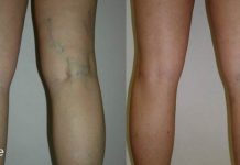 ვენების მოსაშორებლად და კანის სილამაზის დასაბრუნებლად ეს ბუნებრივი კომპონენტებისგან დამზადებული ბალზამი არის საუკეთესო საშუალება!