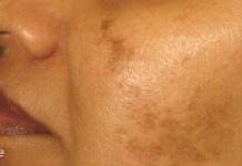 ბუნებრივი გადაწყვეტილებები მუქი ლაქებისთვის, კანის არათანაბარი ტონისთვის და ჰიპერპიგმენტაციისთვის!