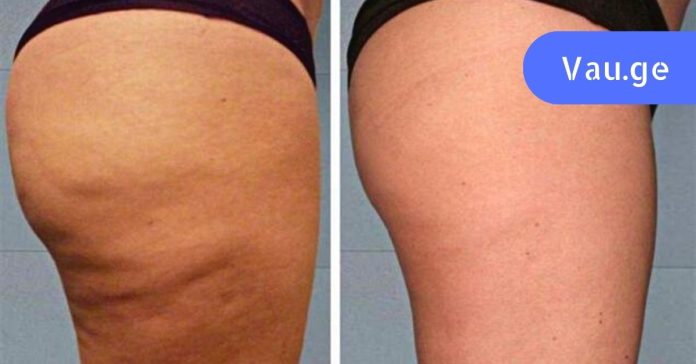 celulitebis-moshoreba