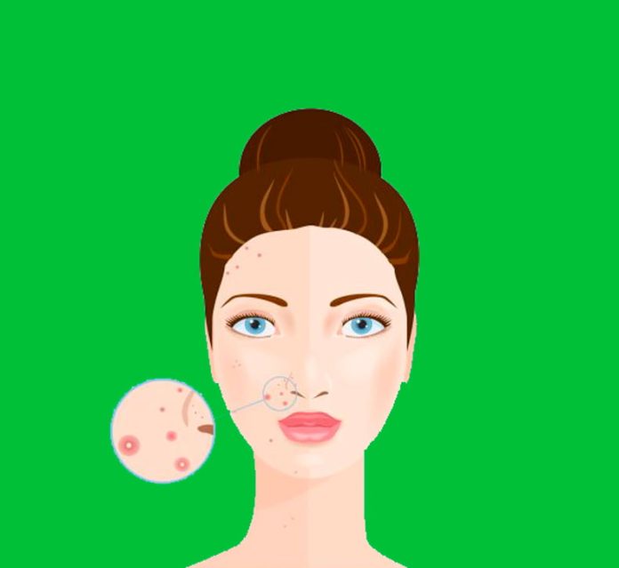 content_комедоны4