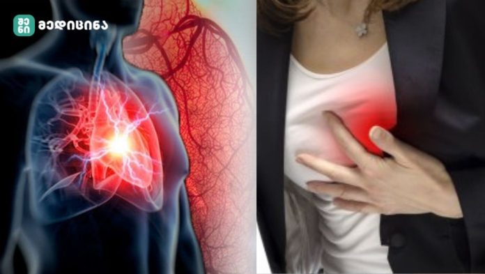 gulis sheteva qalebshi როგორ ვლინდება გულის შეტევის სიმპტომები ქალებში? ამ მინიშნებს ყურადღება უნდა მიაქციოთ