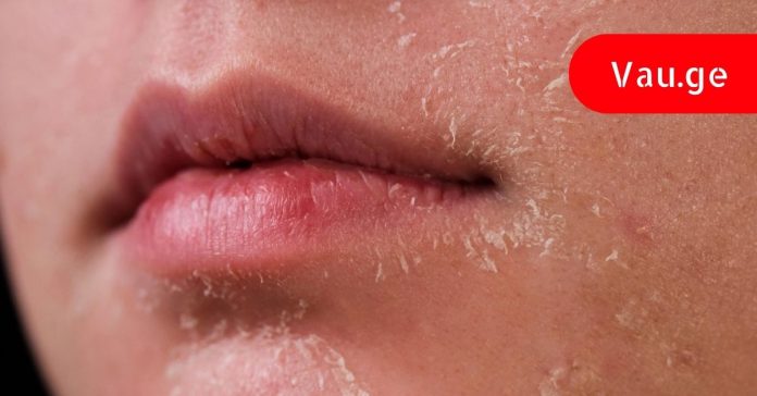 gvidzlis-daaavdebis-simptomebi