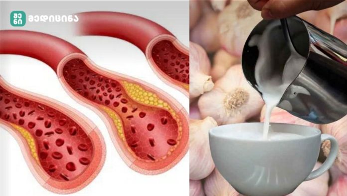 სისხლძარღვების გაწმენდის ეფექტური საშუალება. უკვე წლებია თავი დავაღწიე ხელების დაბუჟებას ამ სამკურნალო მეთოდებით