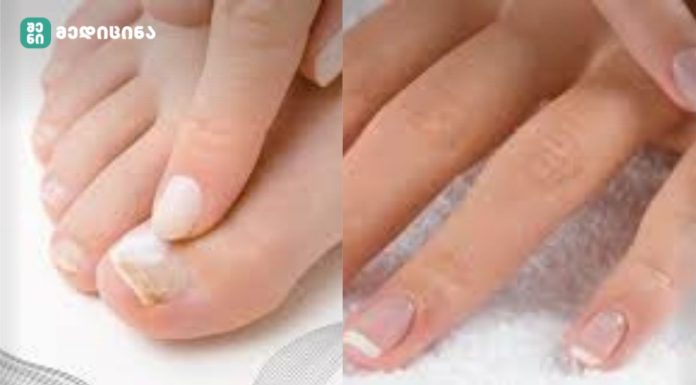 ფეხის ფრჩხილის სოკო!