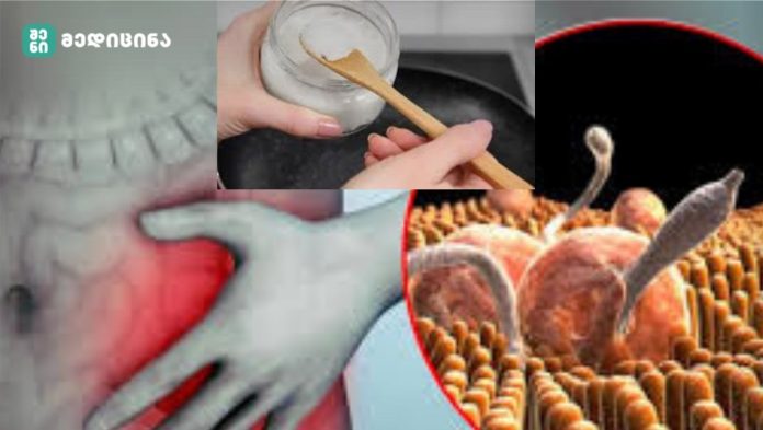 როგორ მოვიშოროთ პარაზიტები, ვირუსები და სოკოვანი ინფექციები! და როგორ მოვახდინოთ ორგანიზმის დეტოქსიკაცია ქოქოსის ზეთით?