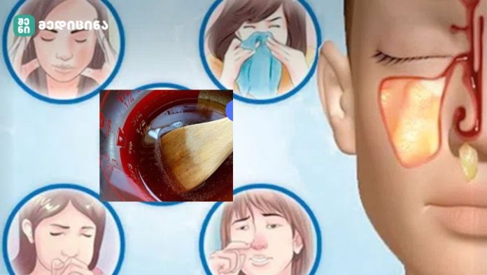 ძალიან ძლიერი საშუალება, რომელიც მოგიხსნით ცხვირიდან გამონადენს, სინუსიტს და დაგავიწყებთ ხველას! სიმპტომები ქრება 24 საათში!