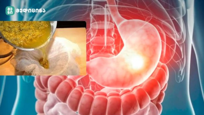 დაივიწყეთ გასტრიტი და გულძმარვა ამ ძლიერი წამლის დახმარებით! - გასტრიტის სამკურნალო ბუნებრივი 5 საშუალება