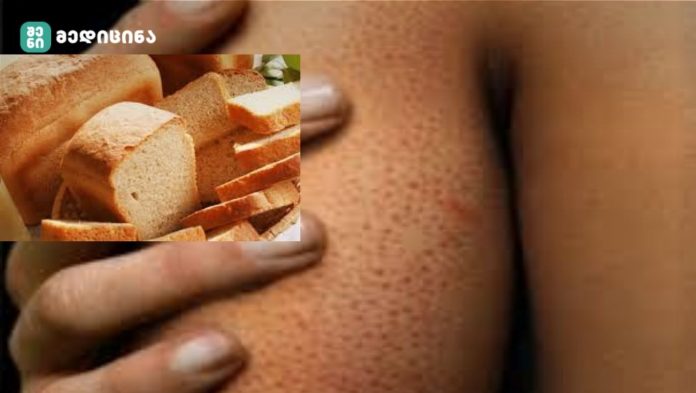 “გლუტეინი” - გაეცანით 8 მიზეზს, იქნებ თქვენც გაქვთ გლუტეინის აუტანლობა