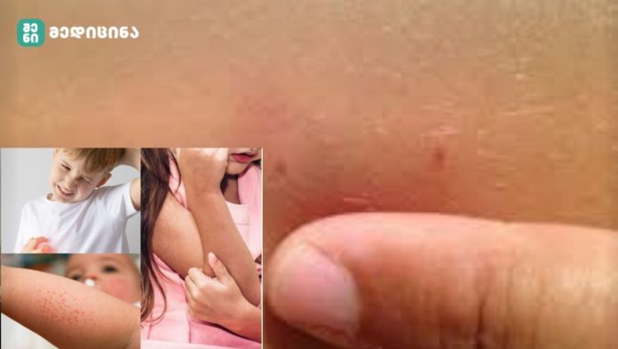 მუნის მკურნალობა ხალხური მეთოდებით