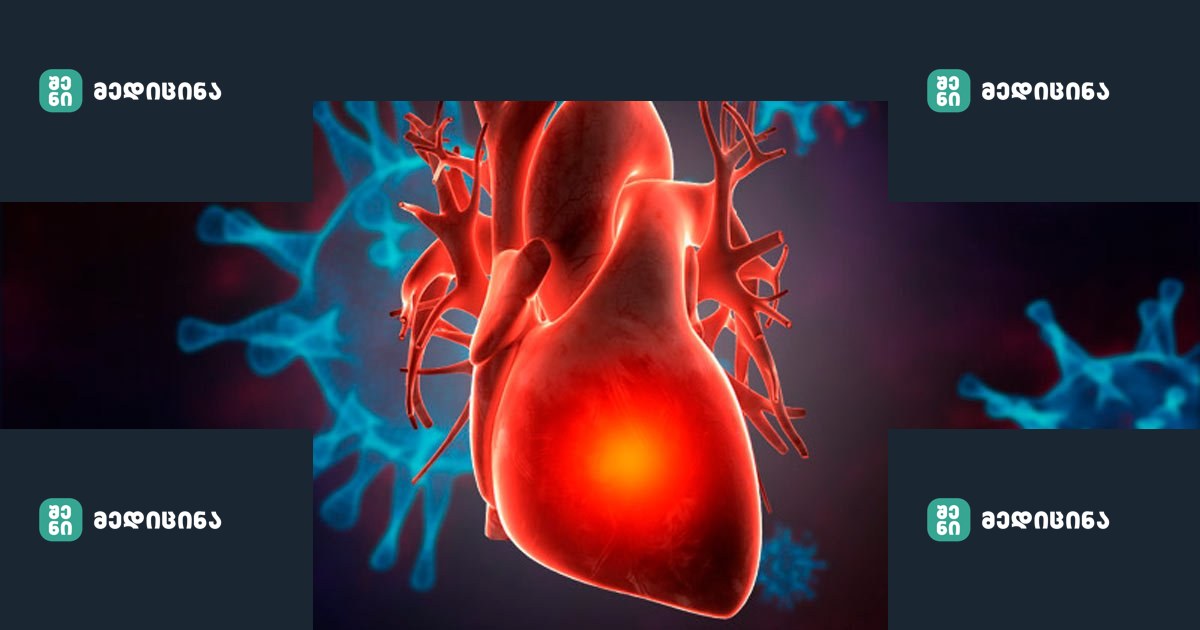 სისხლძარღვების გაწმენდის უნიკალური ხალხური მეთოდები 2 Gulis daavadebebi da koronavirusi