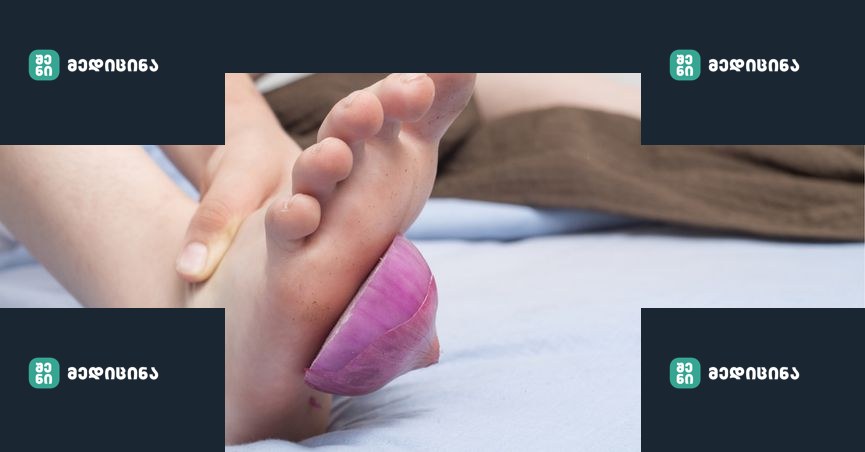 PIC OF ONION ON BOTTOM OF FOOT 1517958639805.jpg 12804217 ver1.0