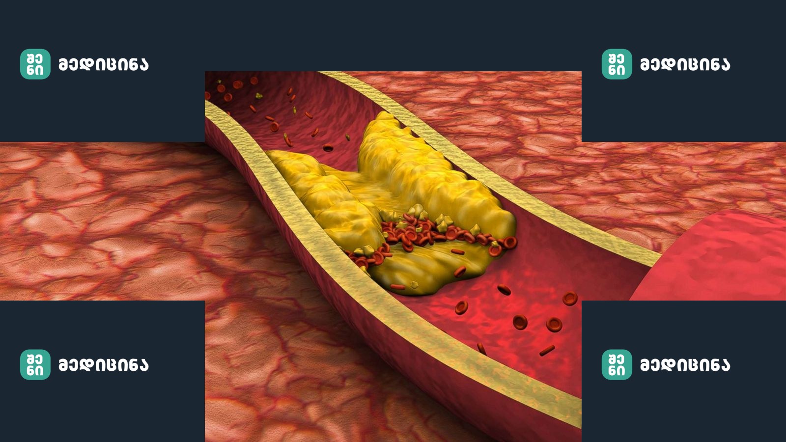 cholesterol illustration rf gty jc