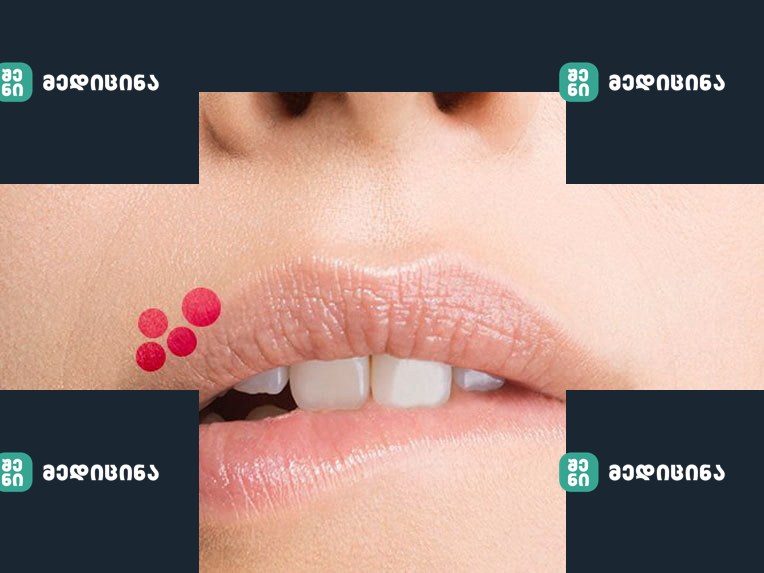 content How to get rid of herpes on the lips