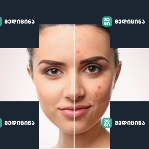 5 ნიშანი სახეზე, რომელიც ორგანიზმში საშიშ მდგომარეობას ამჟღავნებს 1 lui 15