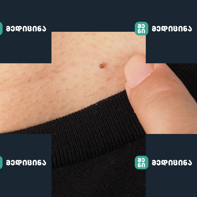 papiloma
