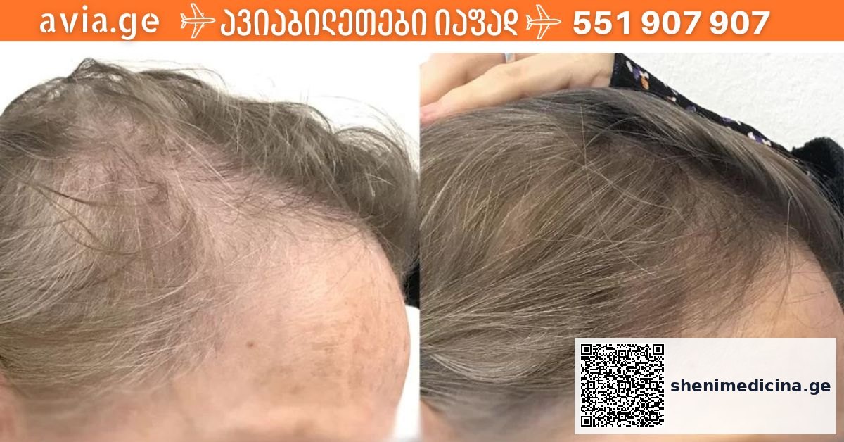 თმის ცვენის მითები და რეალობა - სამეცნიერო მიდგომა თმის მოვლისთვის