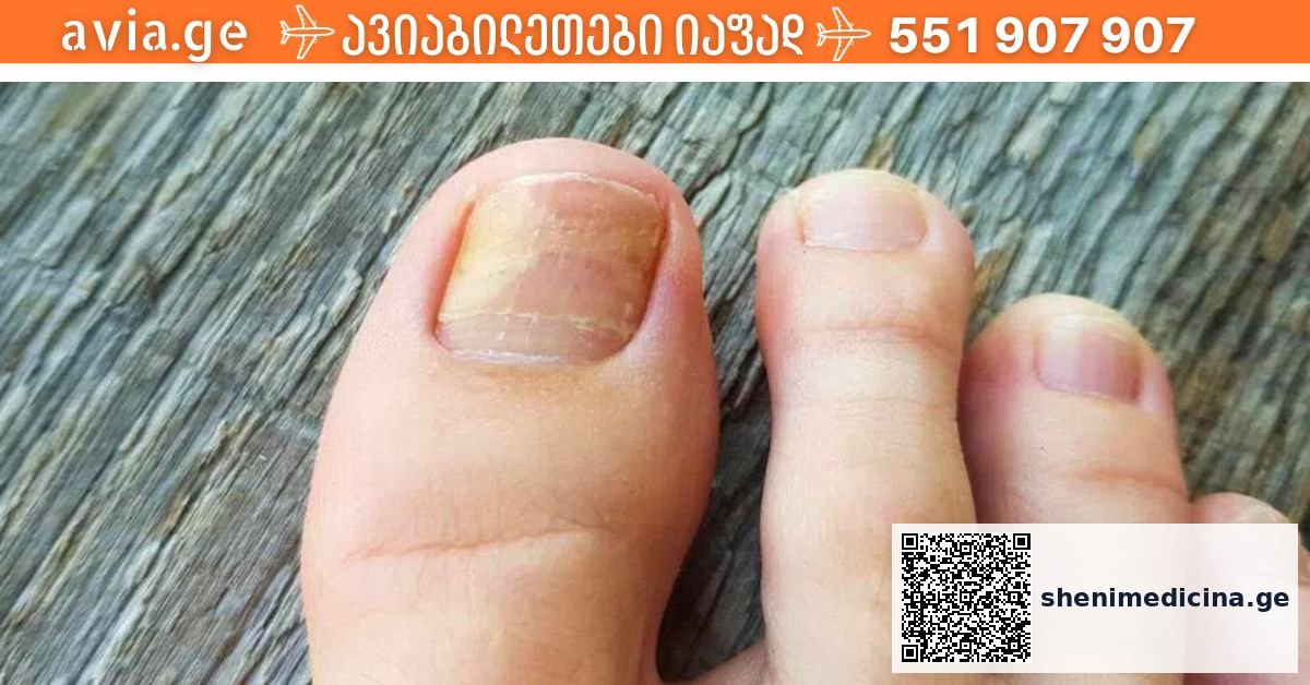 ფრჩხილის სოკოვანი ინფექციის ბუნებრივი მკურნალობა საშინაო საშუალებებით